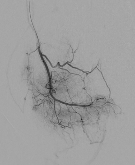 linkes Kniegelenk - vor Behandlung