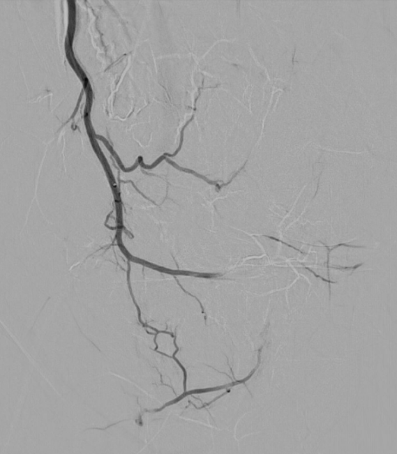linkes Kniegelenk - nach Behandlung